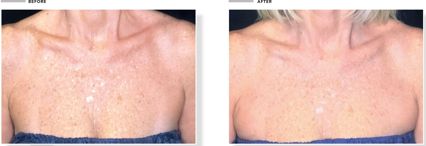 Omnilux Contour Neck & Décolleté LED Light Therapy Mask