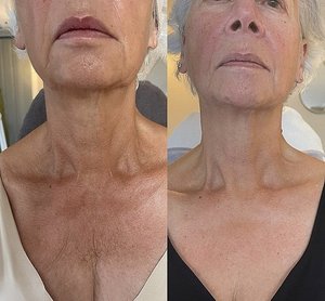 KrX Neck Lift Intensive Firming Cream